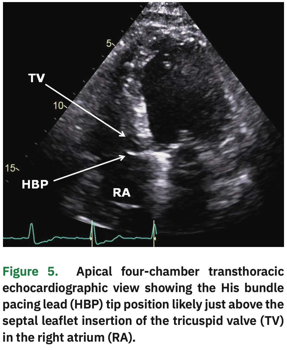 Atrioventricular Node Ablation Combined with His Bundle Pacing to